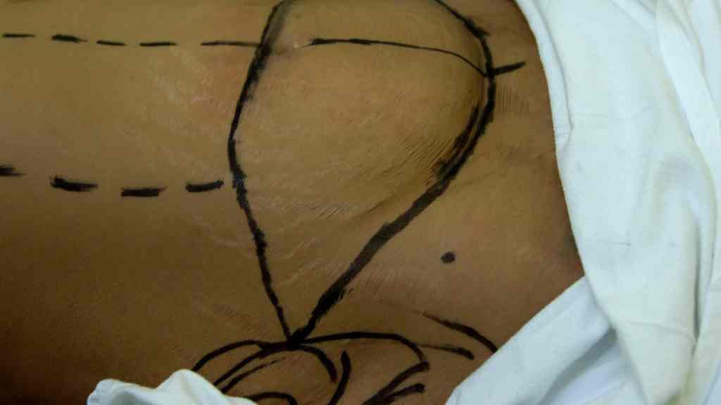 Mexican Nurse Dies After Performing Liposuction On Herself